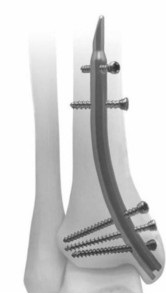 Великогомілковий дистально-медіальний блокуючий стержень